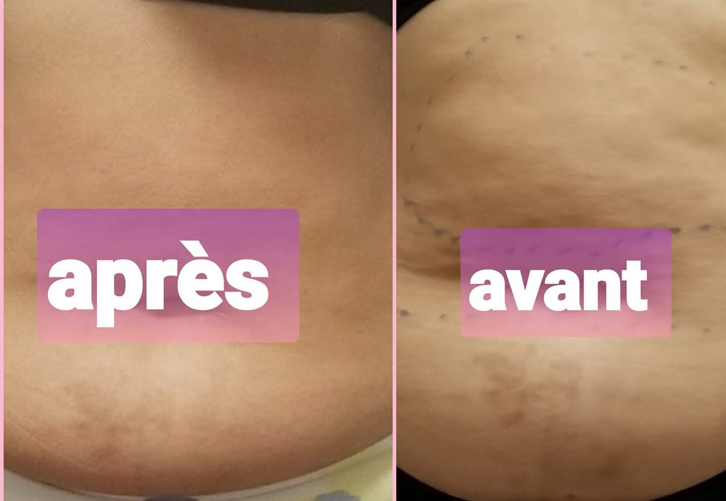 Ulthérapie - Avant et Après