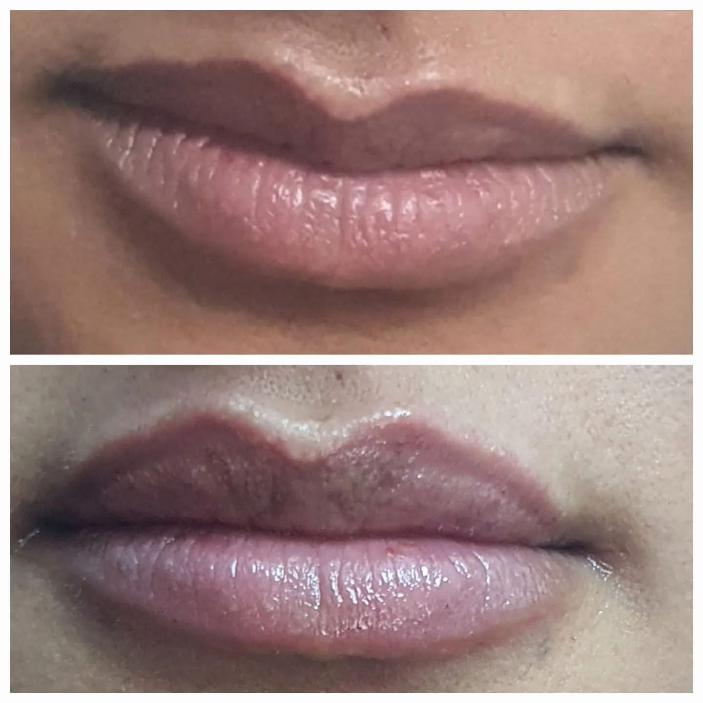 Embellir les lèvres - Avant et Après